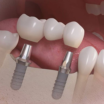 implante-dental