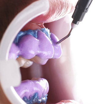 clareamento-dental